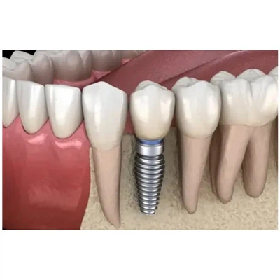 Koji abutment odabrati za restauraciju zubnih implantata?