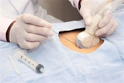 Rak dojke Biopsija: Rizici metastaze, fine igle protiv jezgre igle i 11 druga...